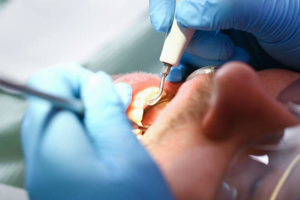 Best Root Canal Emergency Dentist  in Holiday Valley, OH